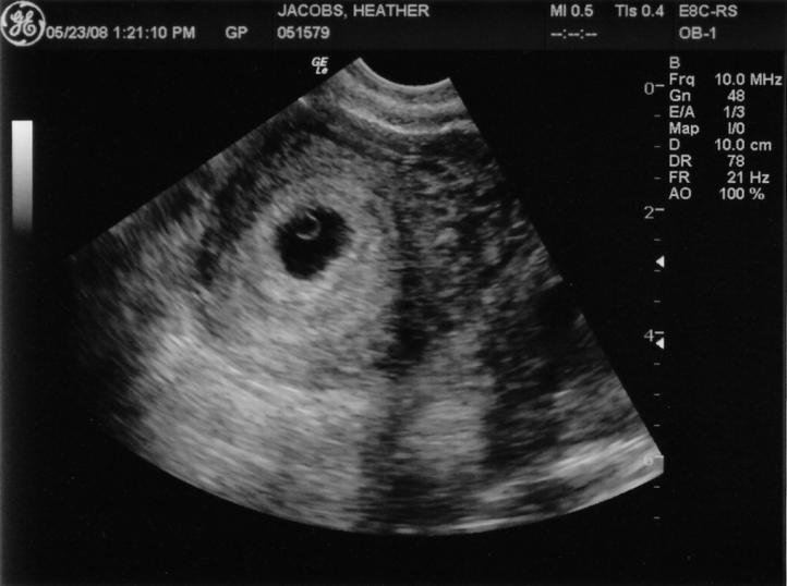 УЗИ на 4 неделе беременности